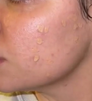 SHIMANI - Shoot The Pimple Acne Corrector / Пъпкотрепач-коректор за пъпки, черни точки и акне . 8 ml